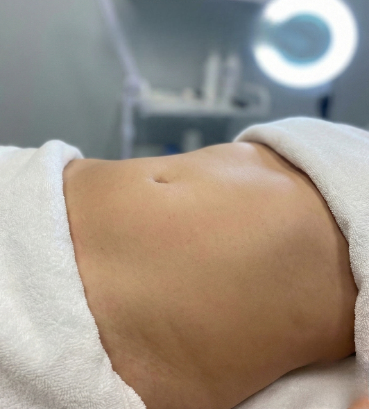 Cryo slimming before and after results in Renton, WA — Cryo Sanctuary