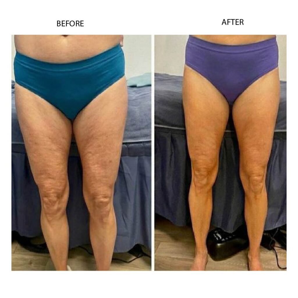 Cryo slimming before and after results in Renton, WA — Cryo Sanctuary