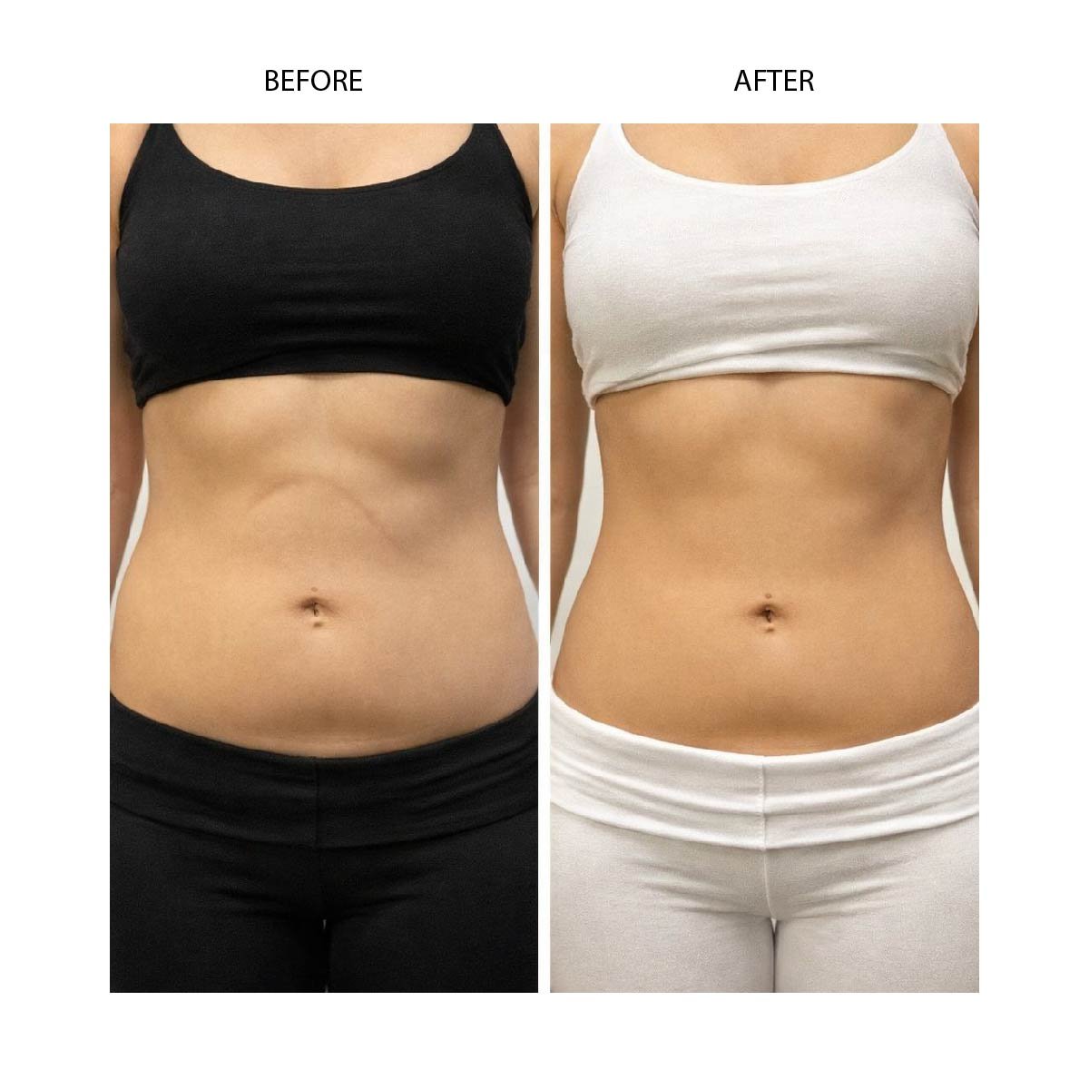 Before After Cryo Slimming