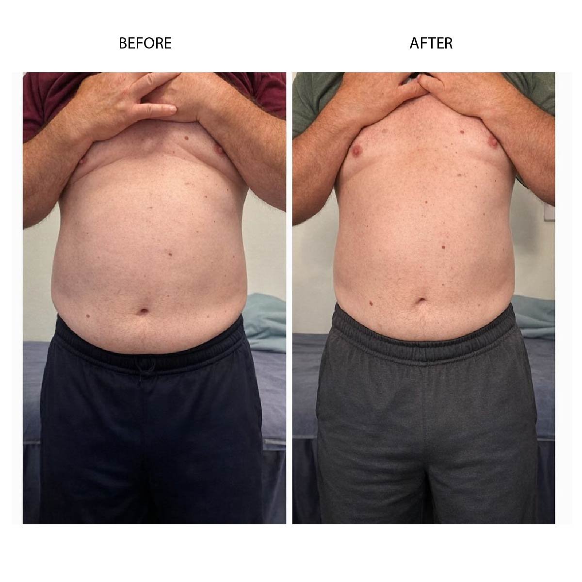 Cryo slimming before and after results in Renton, WA — Cryo Sanctuary
