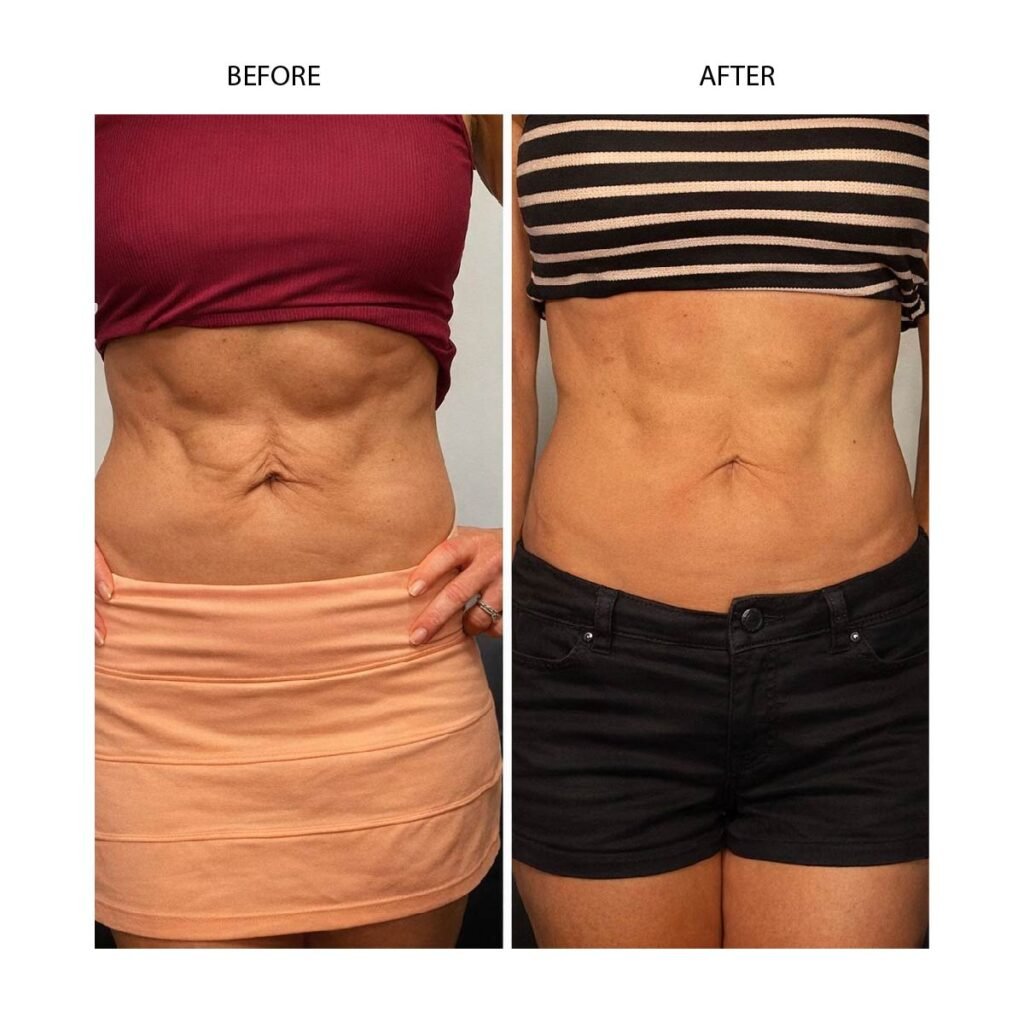 Cryo slimming before and after results in Renton, WA — Cryo Sanctuary