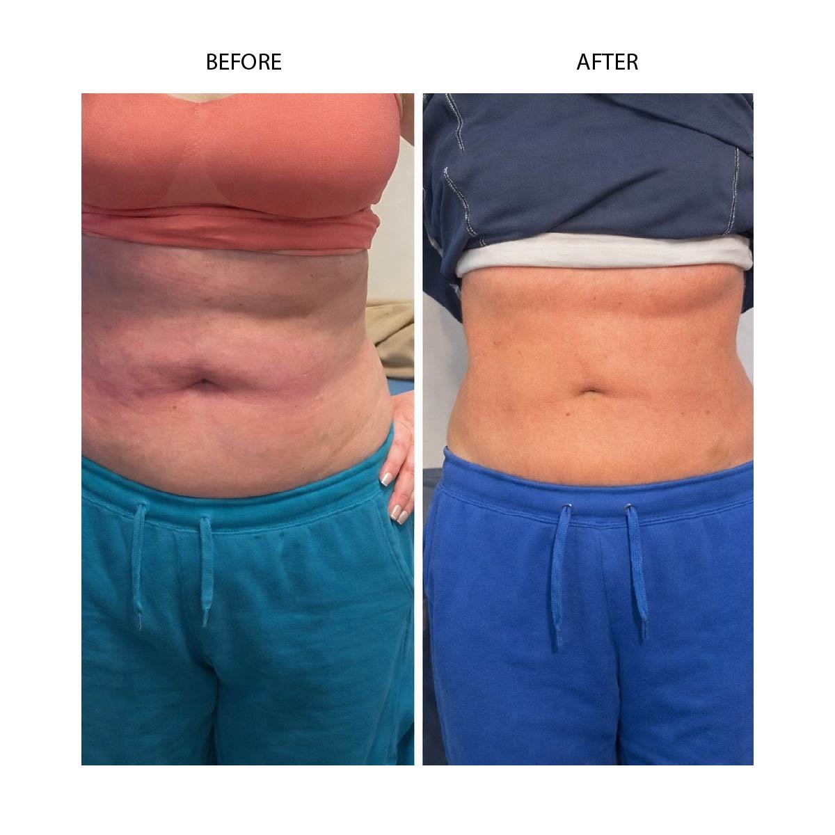 Cryo slimming before and after results in Renton, WA — Cryo Sanctuary