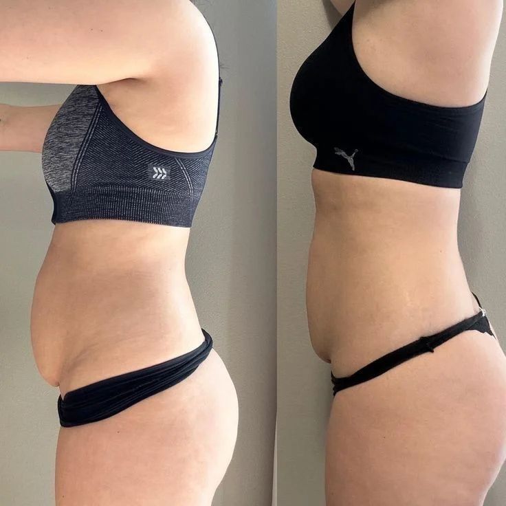 Side-by-side before and after photos showing a reduced belly; left in a gray sports bra, right in a black sports bra and underwear, showing a slimmer silhouette.