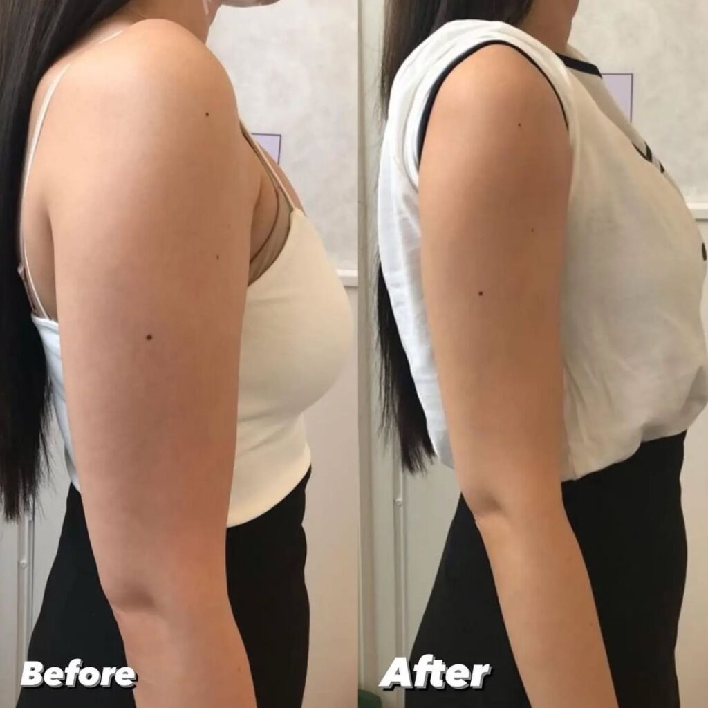 Side-by-side before and after photos of a woman showing improved posture and torso alignment.